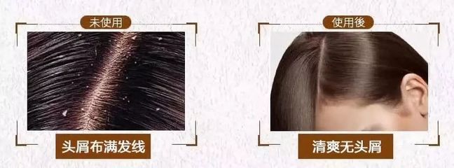 告別脫發、頭皮屑與頭發稀少的煩惱，重塑烏黑濃密的秀發
